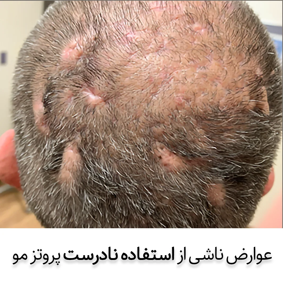 عوارض پروتز مو