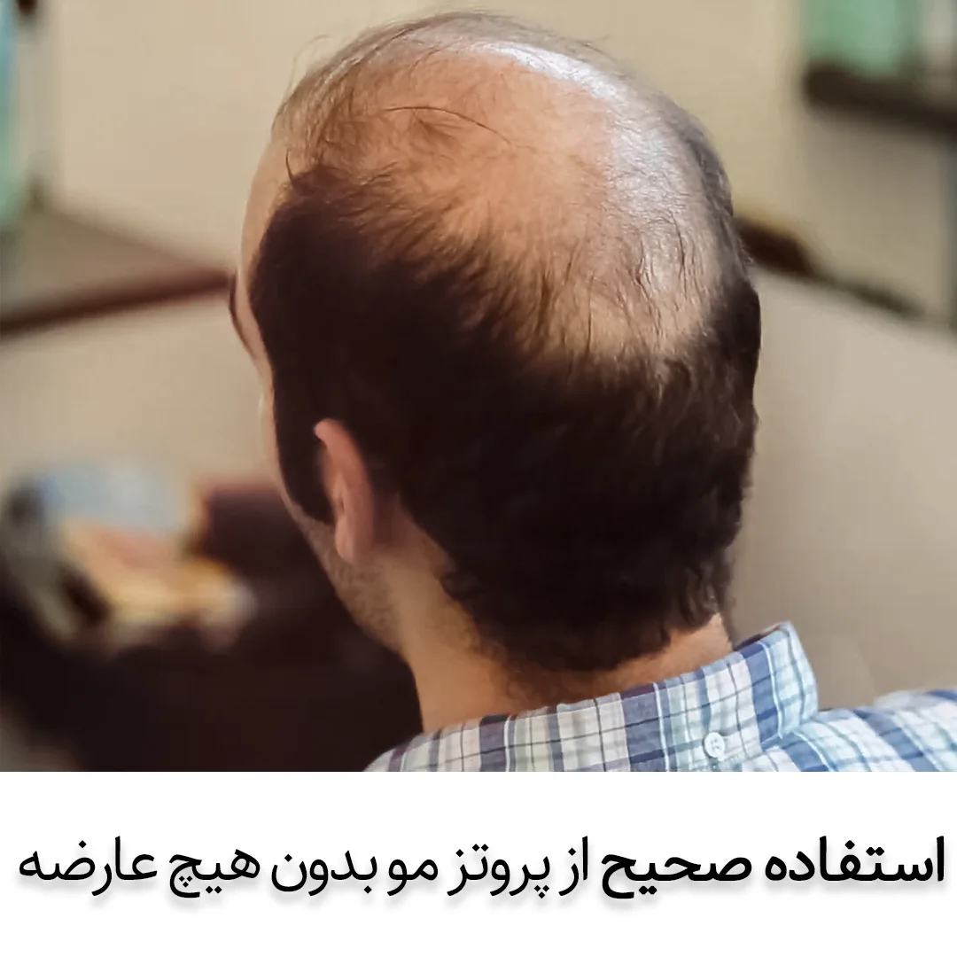 پروتز مو بدون عوارض